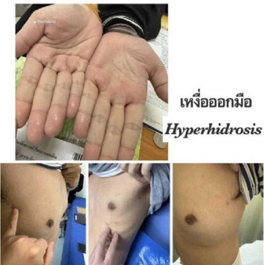 โรคเหงื่อมือ-เท้า พัฒนาการรักษาเพื่อคนไทย                                                         						  	  โดย    รศ.นพ.ศิระ เลาหทัย                                                                                                                                    ศัลยแพทย์ทรวงอกจากศูนย์ผ่าตัดส่องกล้อง   			